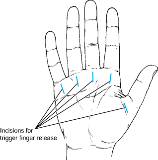 PRINCIPLES OF HAND SURGERY AND SURGICAL APPROACHES TO THE HAND AND ...