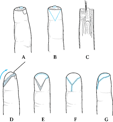 FINGERTIP AND NAIL BED INJURIES - TeachMe Orthopedics