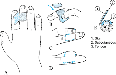 FINGERTIP AND NAIL BED INJURIES - TeachMe Orthopedics