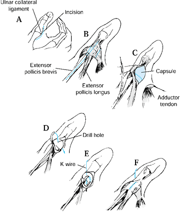 DISLOCATIONS AND LIGAMENTOUS INJURIES OF THE DIGITS - TeachMe Orthopedics