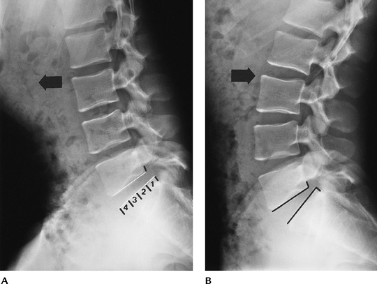 Spine - TeachMe Orthopedics