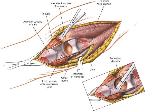 The Elbow - TeachMe Orthopedics