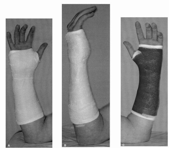 humerus fracture cast