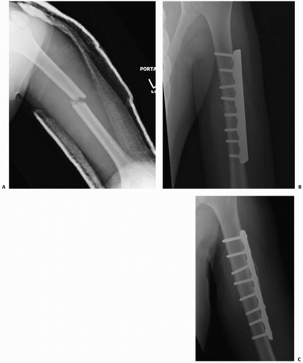 Bone and Joint Healing - TeachMe Orthopedics