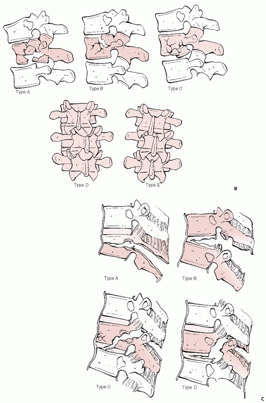 Thoracolumbar Spine Fractures and Dislocations - TeachMe Orthopedics