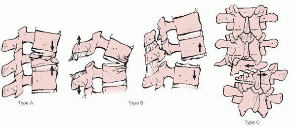 Thoracolumbar Spine Fractures and Dislocations - TeachMe Orthopedics