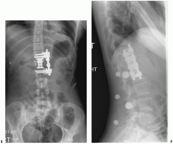 Thoracolumbar Spine Fractures and Dislocations - TeachMe Orthopedics