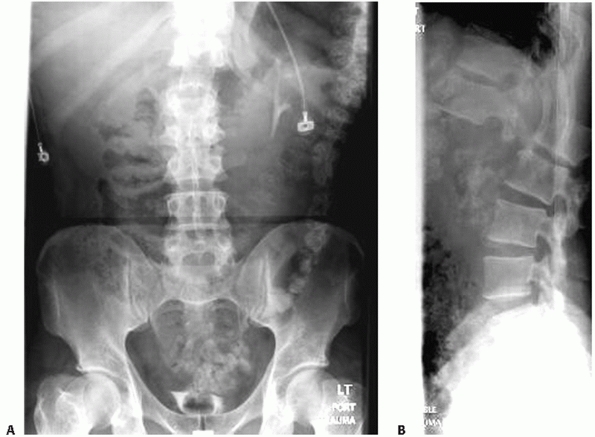 t12 compression fracture