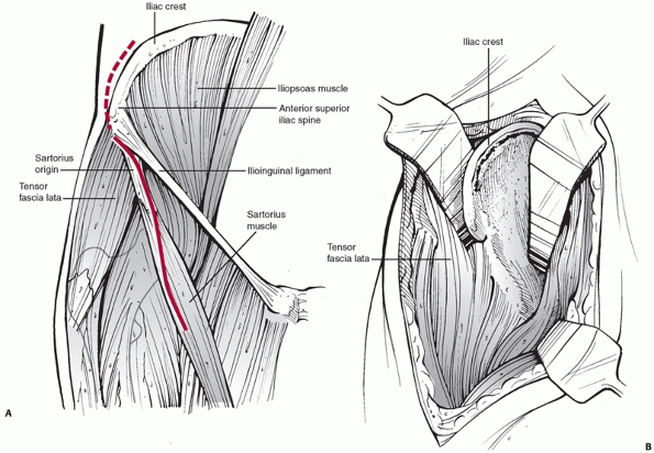 Acetabulum Fractures - TeachMe Orthopedics