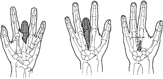 AMPUTATIONS OF THE HAND - TeachMe Orthopedics