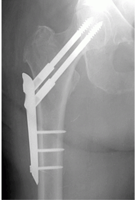 Intertrochanteric Fractures - TeachMe Orthopedics