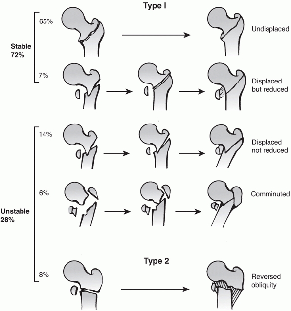 Intertrochanteric Fractures - TeachMe Orthopedics