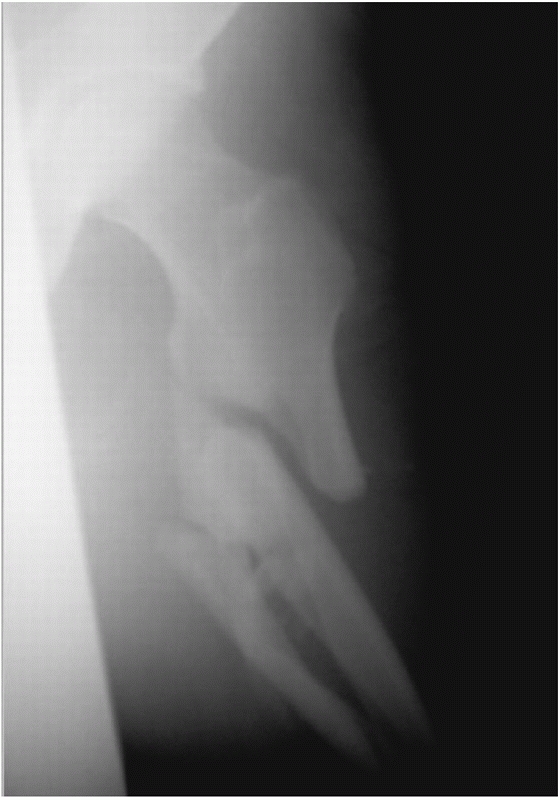 Subtrochanteric Fractures - TeachMe Orthopedics