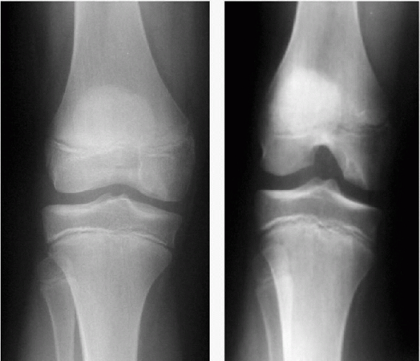 Immature and Adolescent Athletes - TeachMe Orthopedics