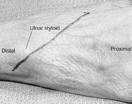 Stenosing Tenosynovitis And Epicondylitis - Teachme Orthopedics