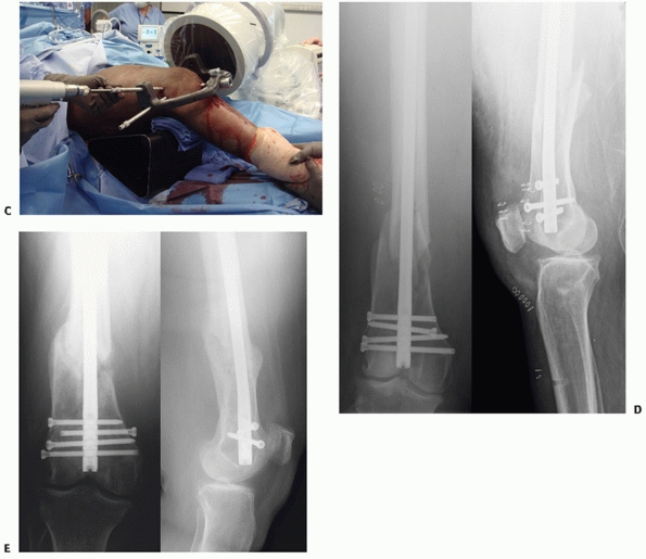 Distal Femur Fractures - TeachMe Orthopedics