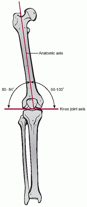 Distal Femur Fractures - TeachMe Orthopedics