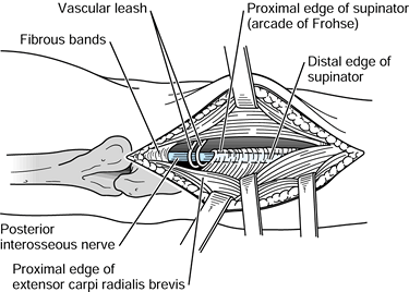 COMPRESSION NEUROPATHIES OF THE UPPER EXTREMITY - TeachMe Orthopedics