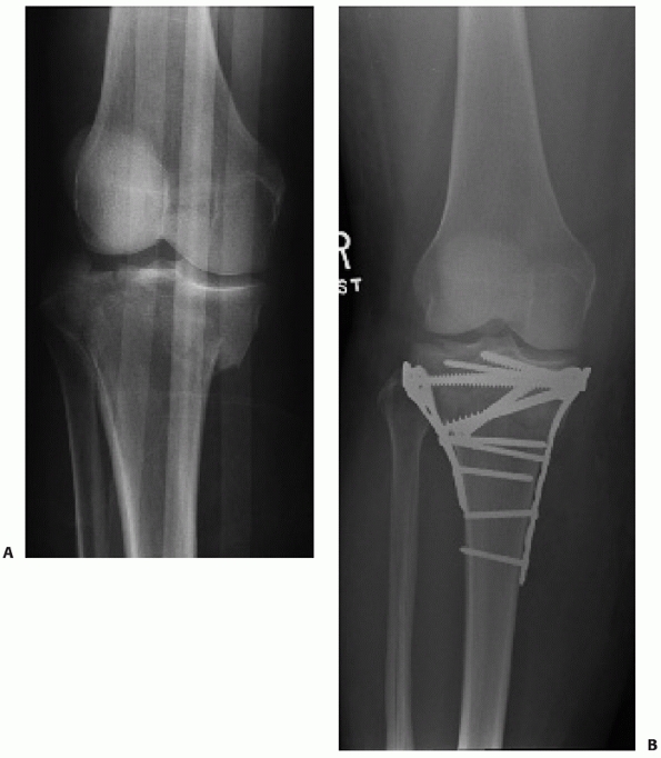 Tibial Plateau Fractures - TeachMe Orthopedics