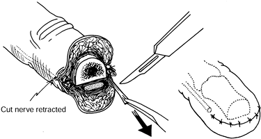 NEUROMAS - TeachMe Orthopedics