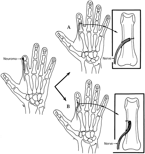 NEUROMAS - TeachMe Orthopedics