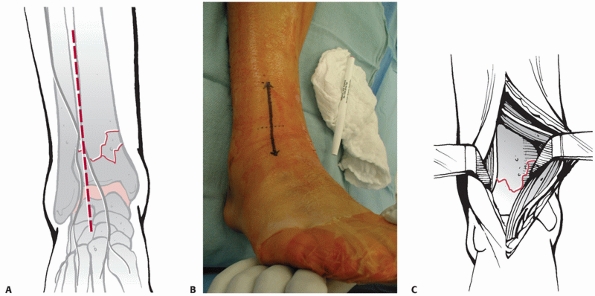 Pilon Fractures - TeachMe Orthopedics