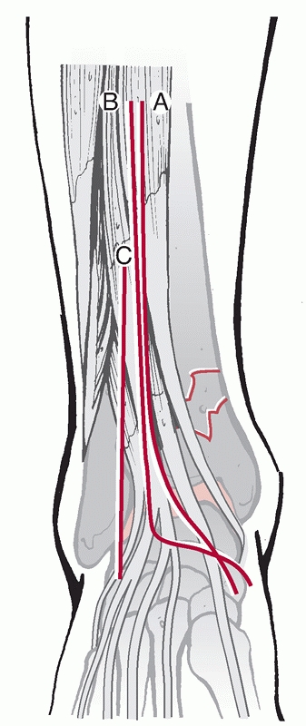 Pilon Fractures - TeachMe Orthopedics