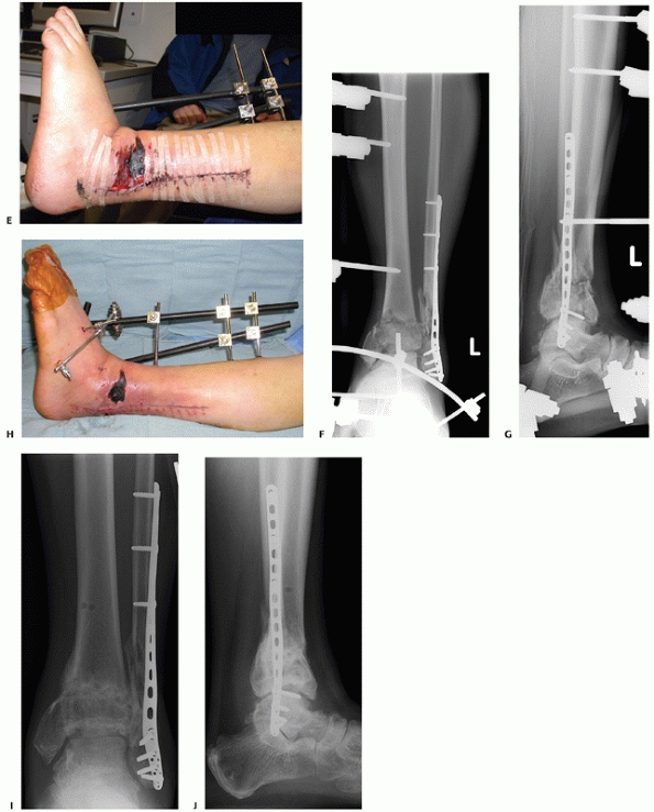 pilon fracture recovery blog