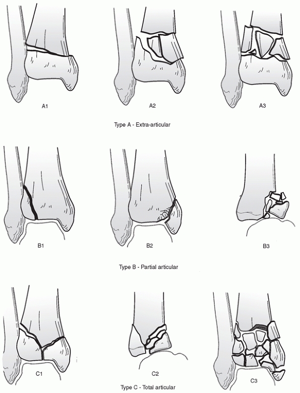 Pilon Fractures - TeachMe Orthopedics