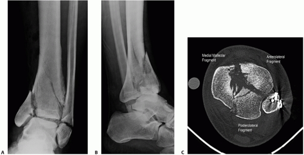 Pilon Fractures - TeachMe Orthopedics