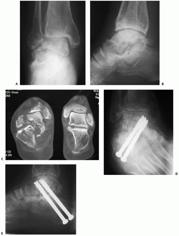 Talus Fractures - TeachMe Orthopedics