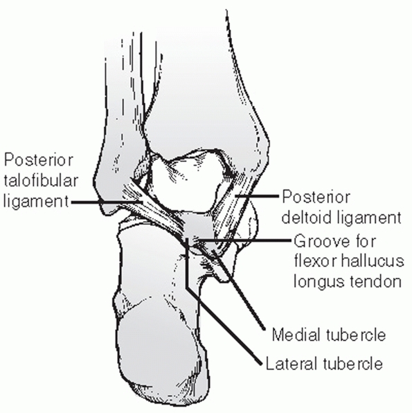 Talus Fractures - TeachMe Orthopedics