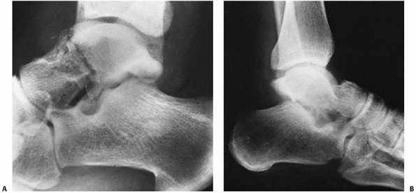 Talus Fractures - TeachMe Orthopedics