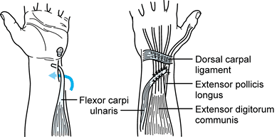 TENDON TRANSFERS IN COMBINED NERVE PALSIES OF THE FOREARM AND HAND ...