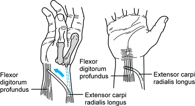 TENDON TRANSFERS IN COMBINED NERVE PALSIES OF THE FOREARM AND HAND ...