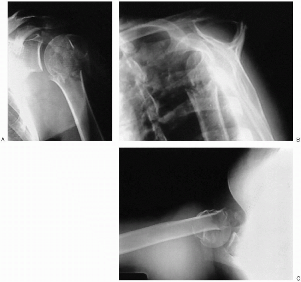 Hemiarthroplasty of the proximal humerus - TeachMe Orthopedics