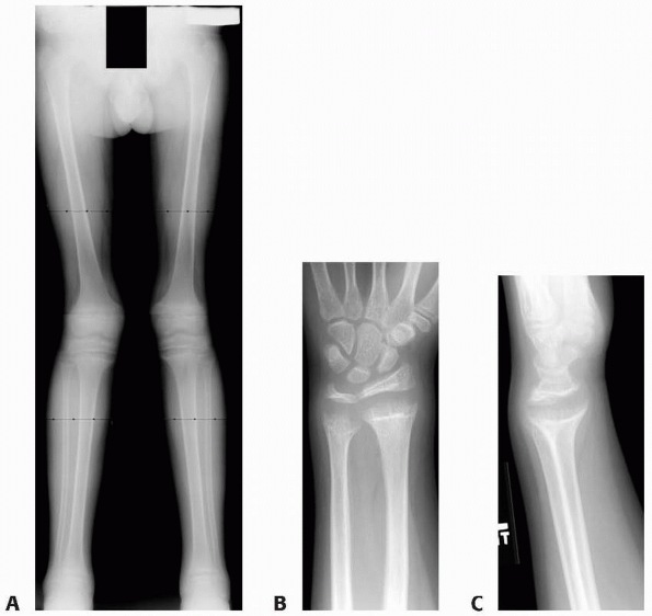 Pathologic Fractures Associated with Tumors and Unique Conditions of ...