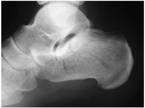 Principles of Nonoperative Fracture Treatment - TeachMe Orthopedics