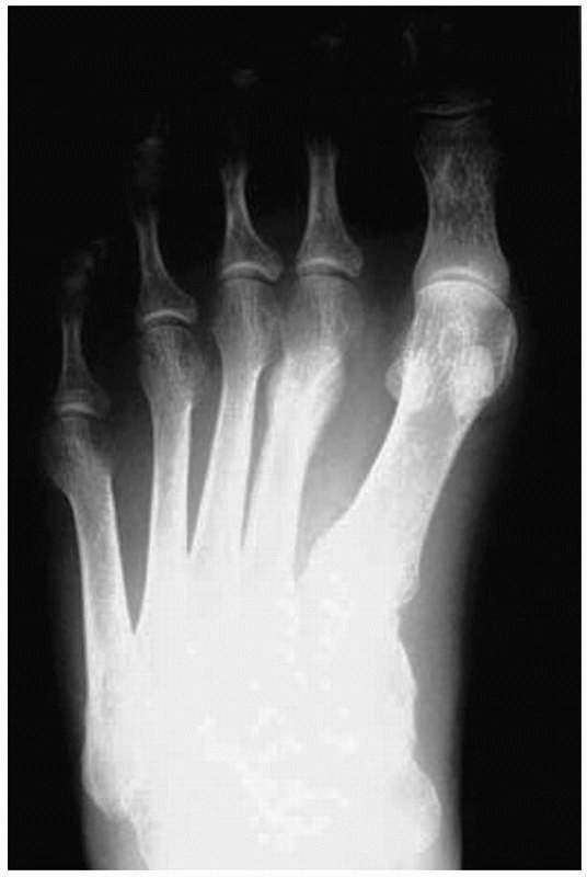 Principles Of Nonoperative Fracture Treatment - TeachMe Orthopedics