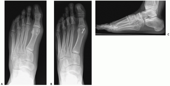 Fractures and Dislocations of the Midfoot and Forefoot - TeachMe ...