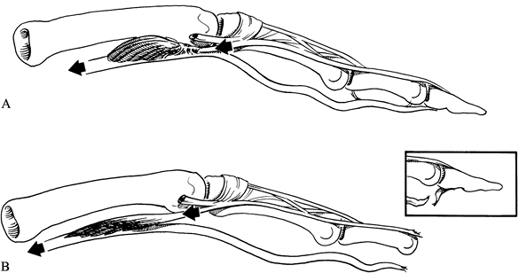 INTRINSIC MUSCLE CONTRACTURES - TeachMe Orthopedics