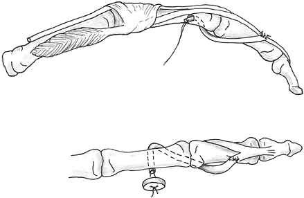 INTRINSIC MUSCLE CONTRACTURES - TeachMe Orthopedics