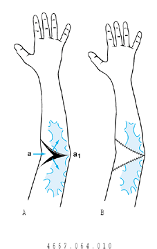 BURN CONTRACTURES - TeachMe Orthopedics