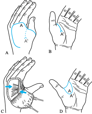 CONGENITAL HAND MALFORMATIONS - TeachMe Orthopedics