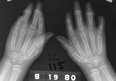 CONGENITAL HAND MALFORMATIONS - TeachMe Orthopedics