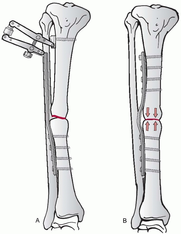 Principles of Internal Fixation - TeachMe Orthopedics