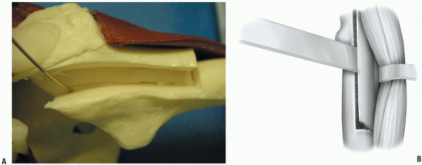 Hip and Acetabulum - TeachMe Orthopedics