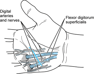 INFECTIONS OF THE HAND - TeachMe Orthopedics