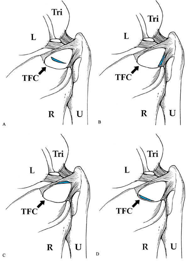 Arthroscopic Surgery Of The Wrist - Teachme Orthopedics