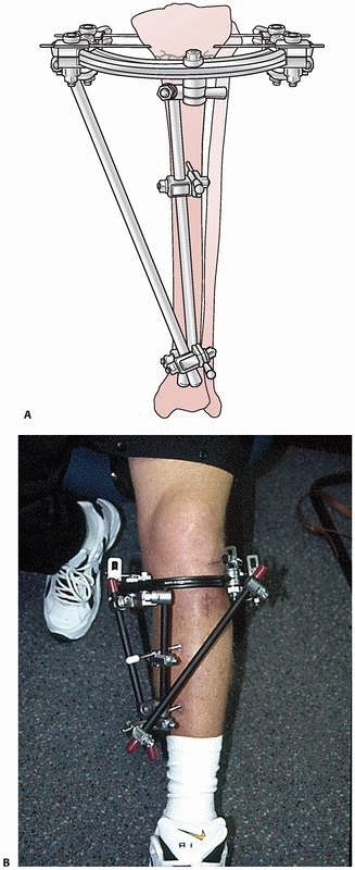 Principles Of External Fixation - TeachMe Orthopedics